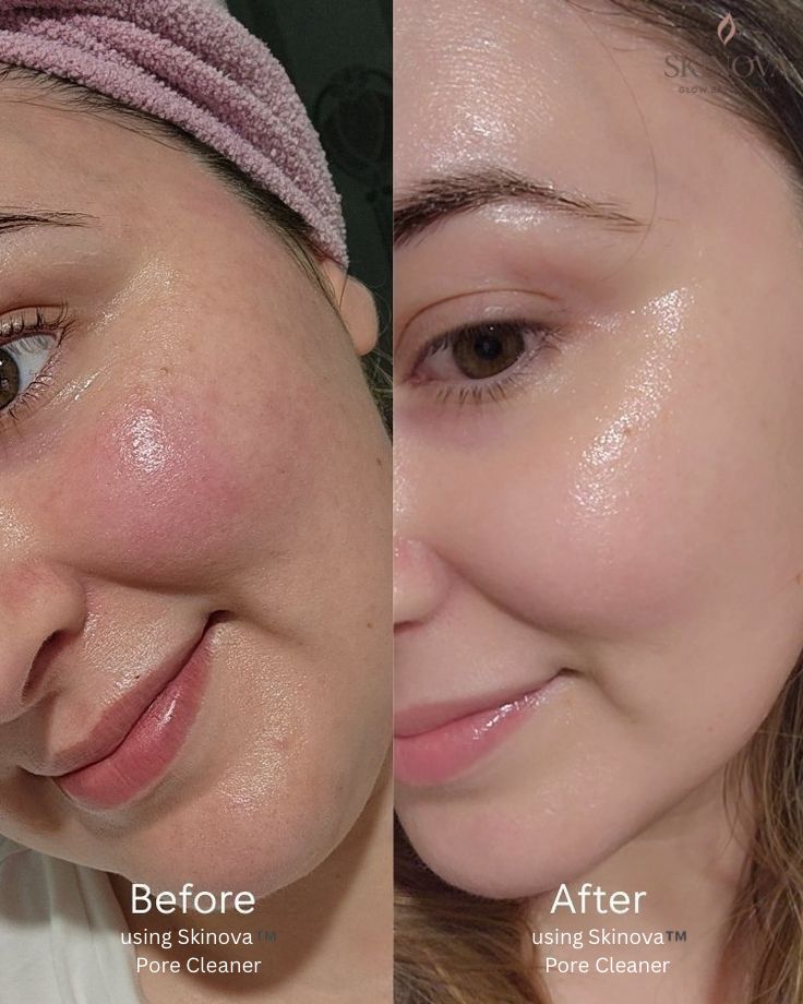 Skinova™️ Blackhead Remover — Clear Skin Fast